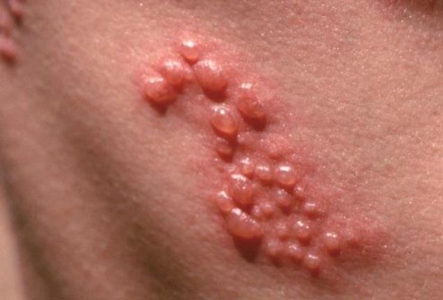 Shingles / Postherpetic Neuralgia