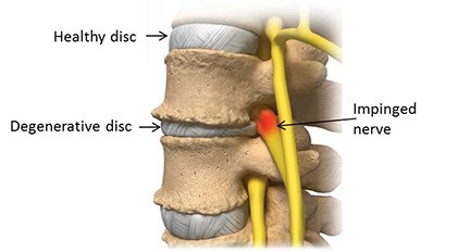 Disc Degeneration & K Laser Therapy